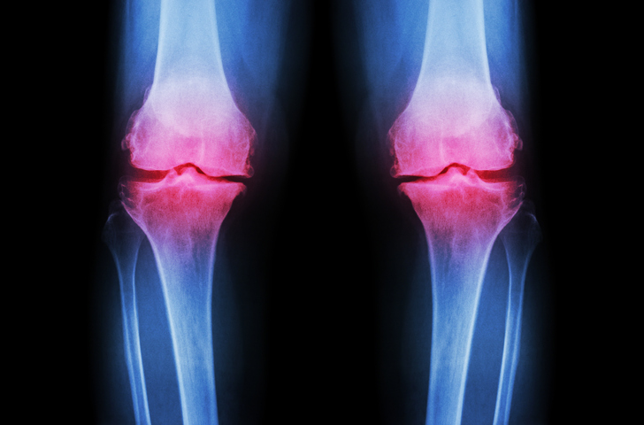 Walking eases pain of knee osteoarthritis
