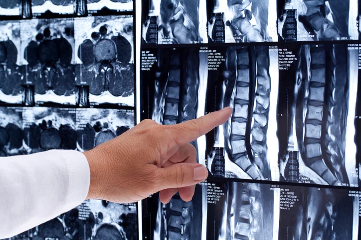 What you need to know about degenerative disc disease
