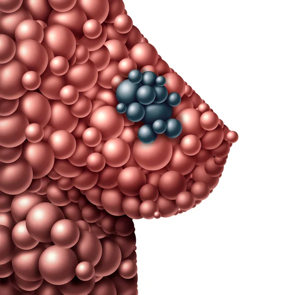What to do if you find a breast lump
