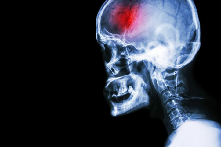 TIAs – a red flag warning of possible stroke