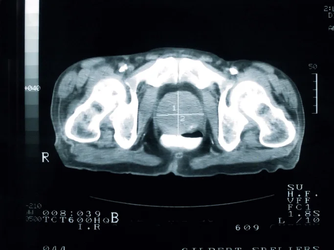 The Most Promising And Recent Break Throughs In Treating Prostate Cancer