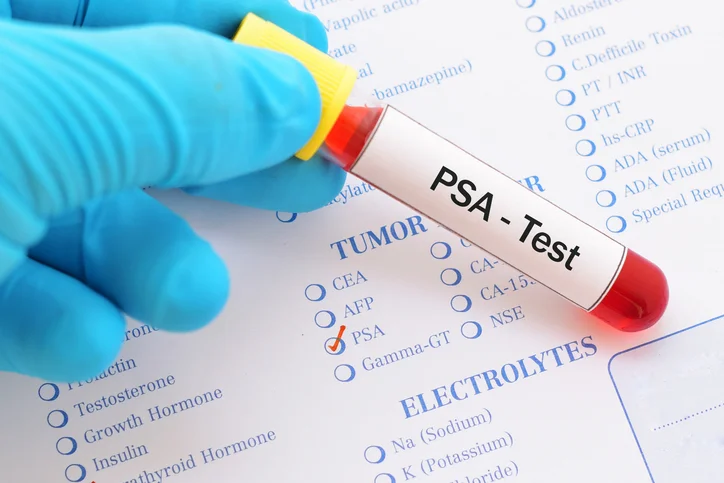 Dealing with a High PSA When It is Not Cancer