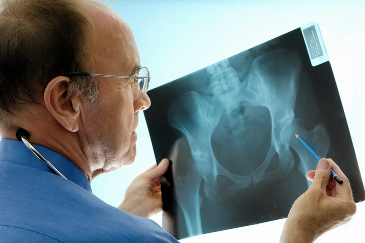 Besides women, osteoporosis also strikes men