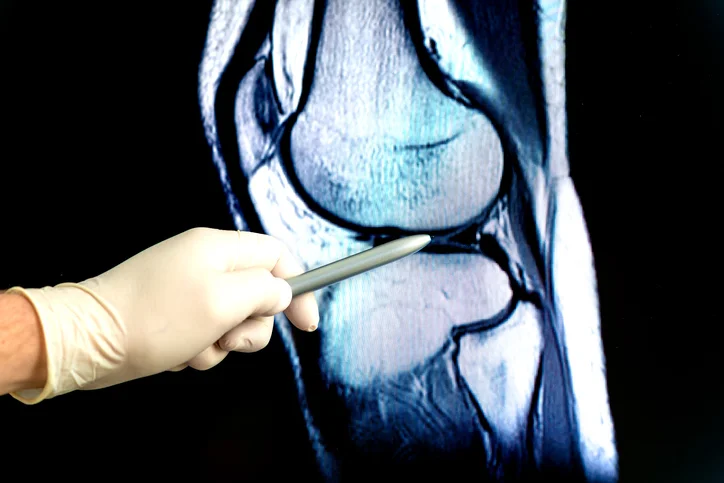 Why women are more prone sports-related knee injuries