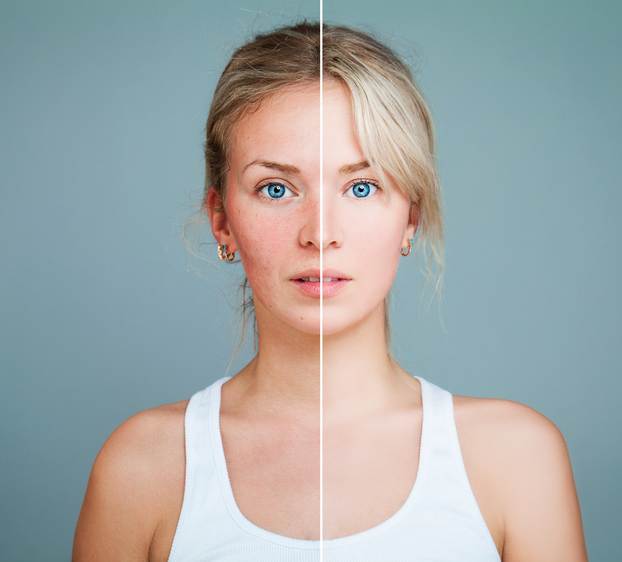 6 tips minimizing rosacea flare-ups in cold weather