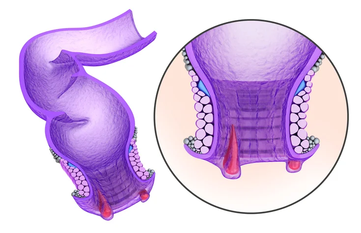 Treating hemorrhoids at home