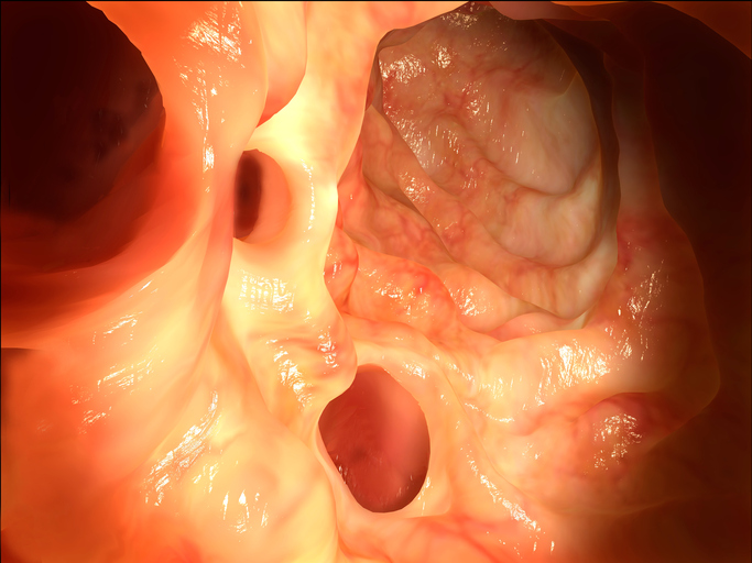 The details on identifying diverticulitis