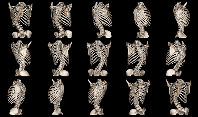 Scoliosis – could you have it and not know it?
