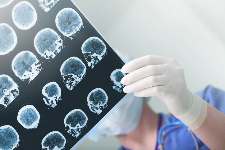 Exercise improves quality of life for Parkinson’s patients