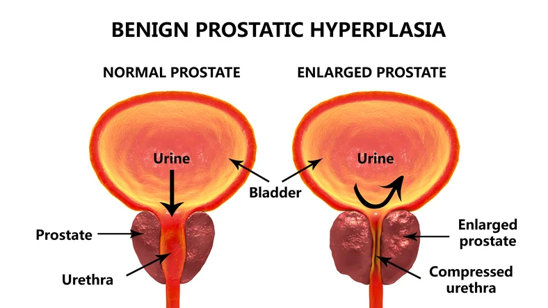 How is BPH different from prostate cancer?
