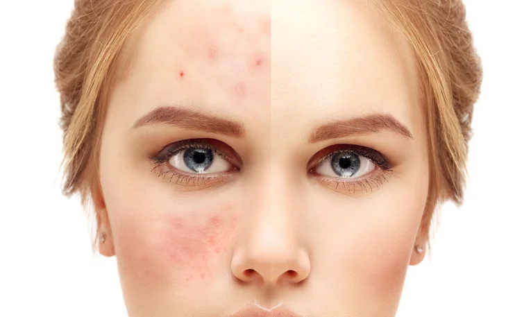 Treating hives before they get out of hand