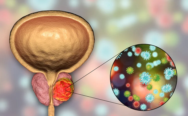 Advanced Prostate Cancer Diagnosis
