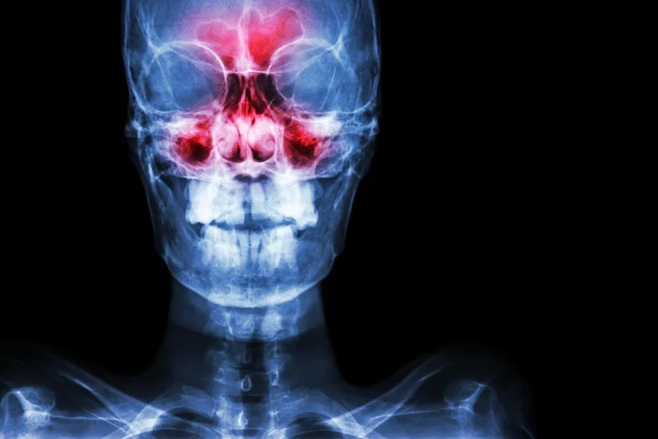 Could your cold really be a sinus infection?  How to know