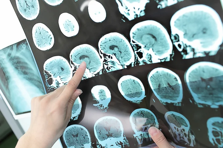 Understanding what is a subdural hematoma