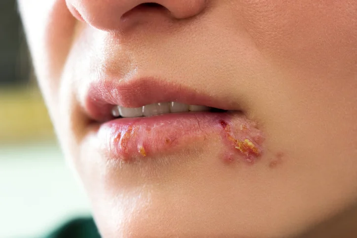 10 facts about herpes everyone should know