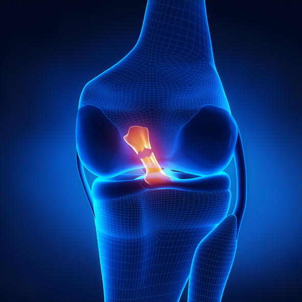 What to do with a torn meniscus