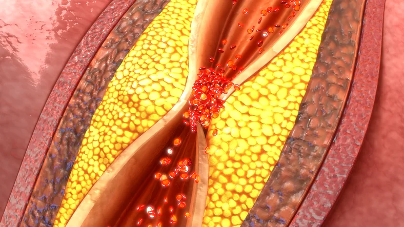 How atherosclerosis harms our arteries