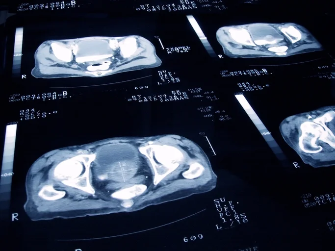 Two new drugs stall progression of hard-to-treat prostate cancer