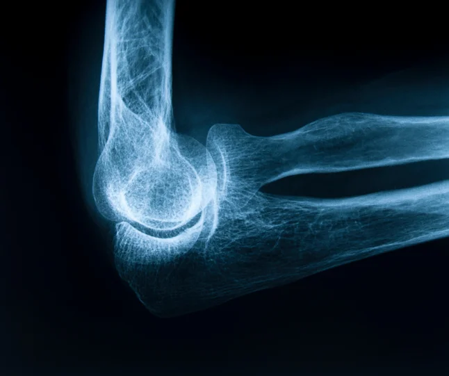 Women and their risk of osteoporosis