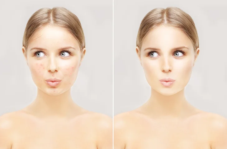 Could you have rosacea and not know it?
