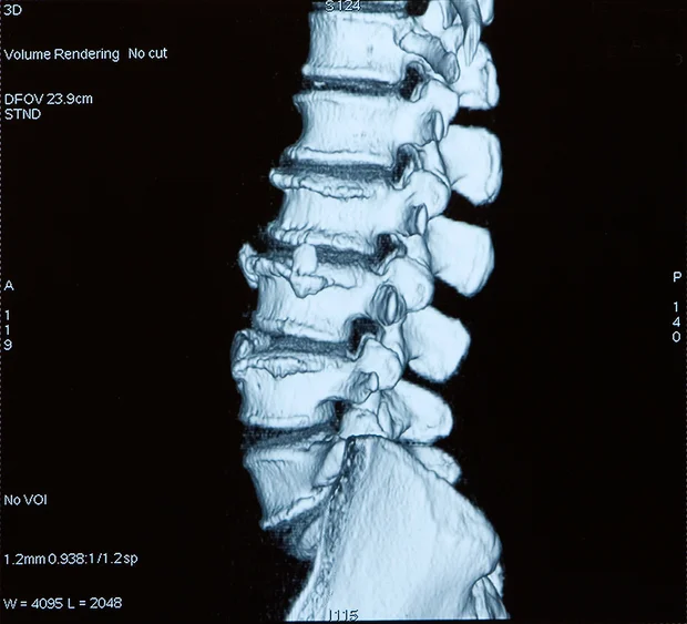 Learning to live well with spinal stenosis