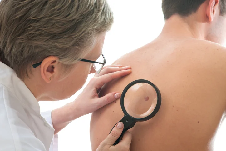 Why melanoma kills more men than women