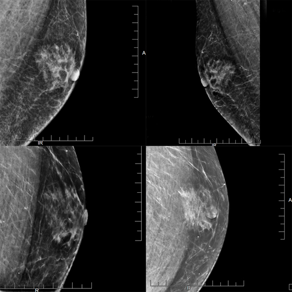 What does it mean to have dense breasts?