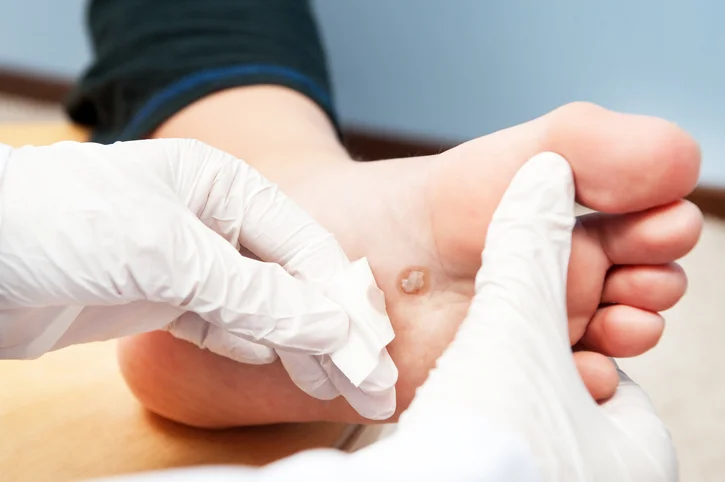 Never ignore diabetic foot ulcers