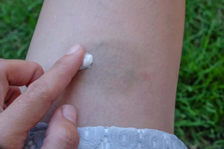 Why do I bruise more easily with age? 