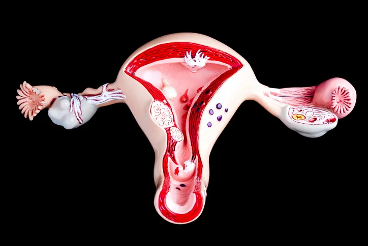 10 revealing symptoms of endometriosis