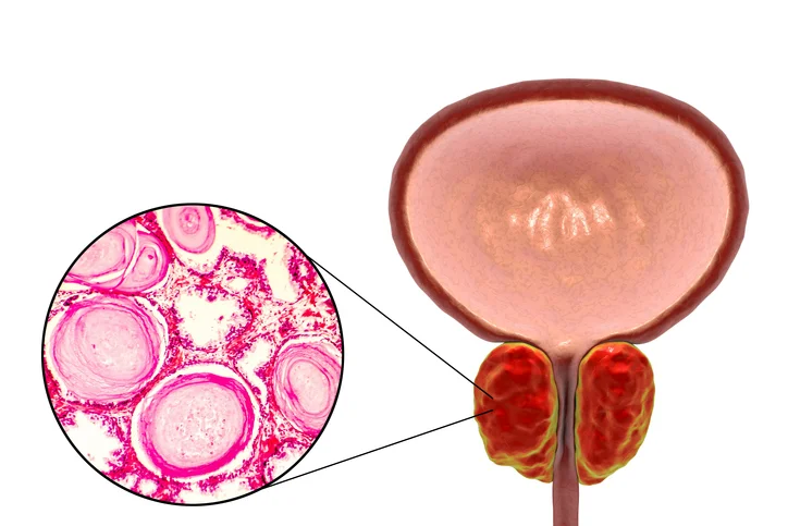 The basics of a prostate biopsy