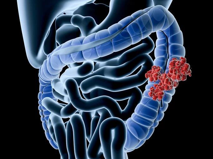 New guidelines recommend screening start at age 45 for colorectal cancer