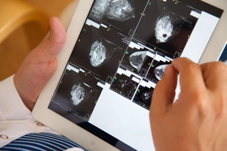 Major study finds early-stage breast cancer patients can safely skip chemotherapy