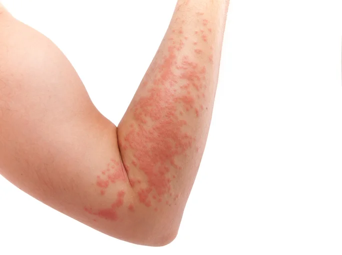 8 facts you need to know about psoriasis