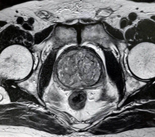 Facts men should know about prostatitis