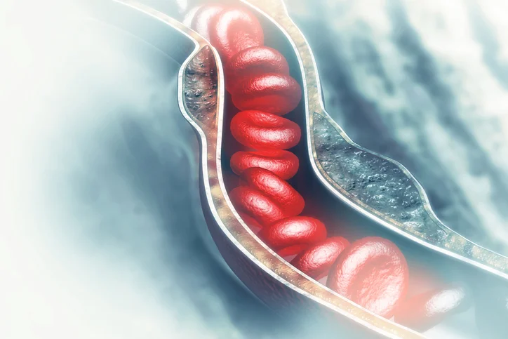 Proactive steps for preventing a blood clot