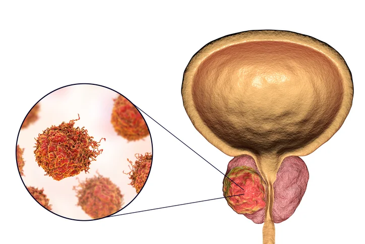 Tests determining if prostate cancer has spread