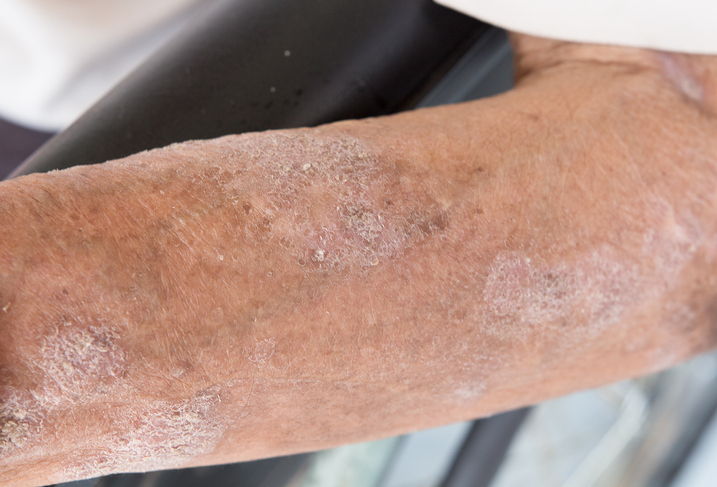 Recognizing signs of cellulitis