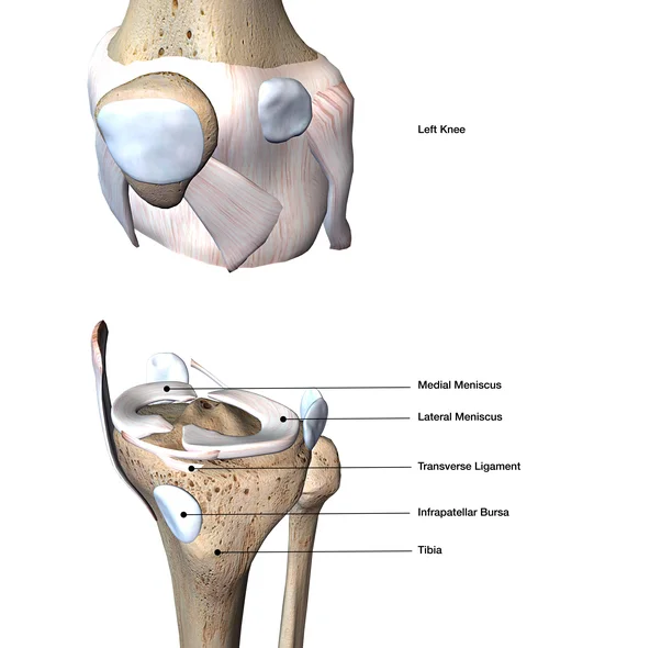Treating a torn meniscus