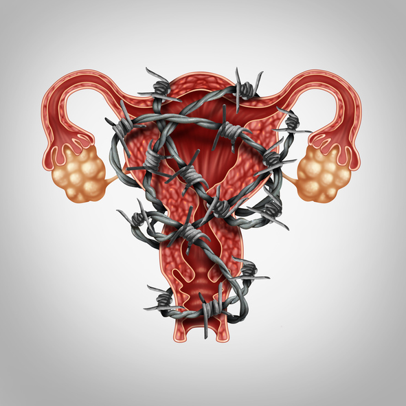 What women should know about endometriosis