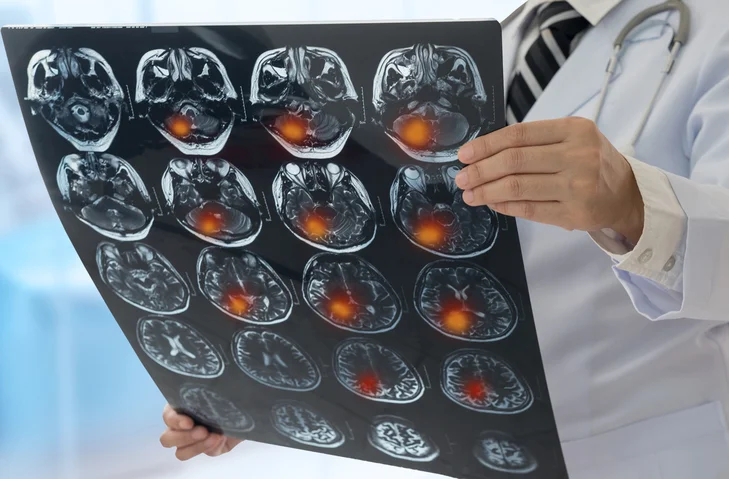 F.A.S.T. thinking saves stroke victims lives