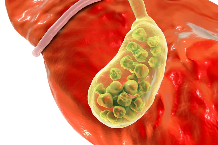 Your gallstone prevention checklist