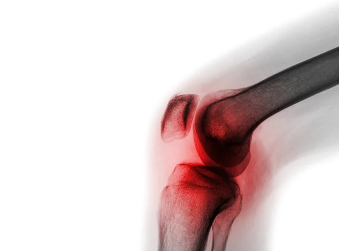 Osteoarthritis: What it is and how to manage it