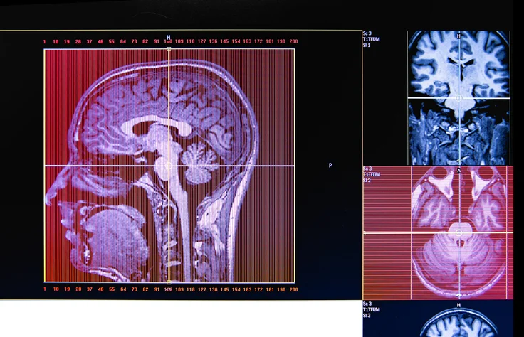 What to do when someone has a seizure