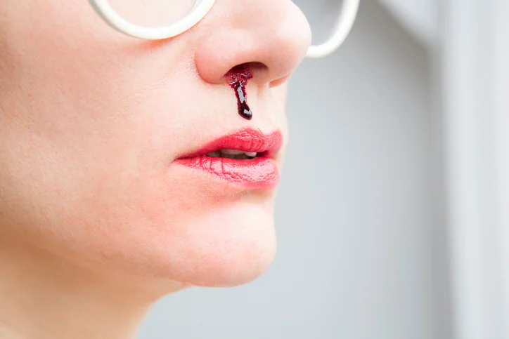 8 ways to stop a nosebleed