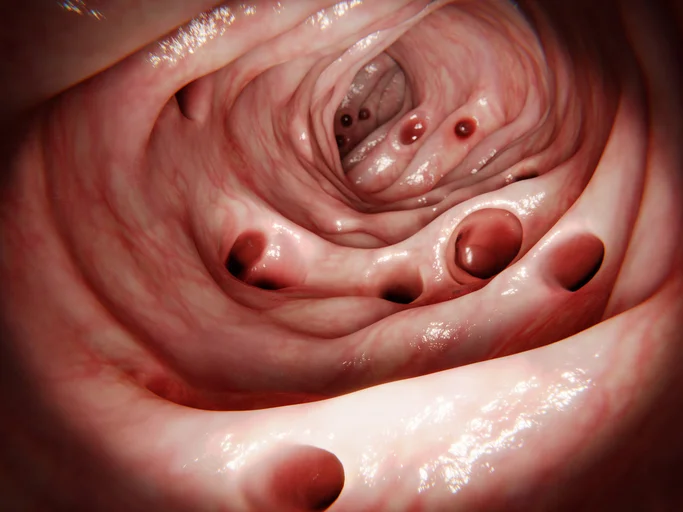 Have a pain in your side? It could be diverticular disease