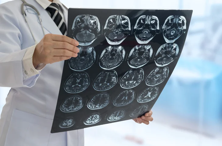 15 surprising facts about stroke