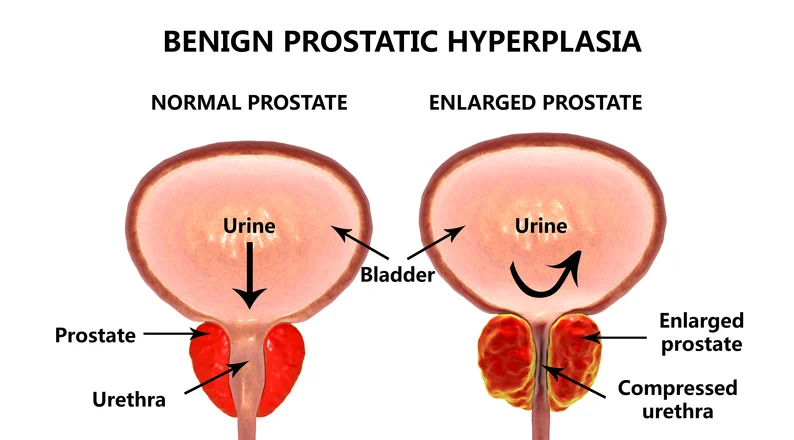 What every man should know about an enlarged prostate