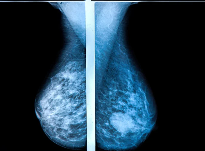 You’ve found a breast lump: What’s the next step?