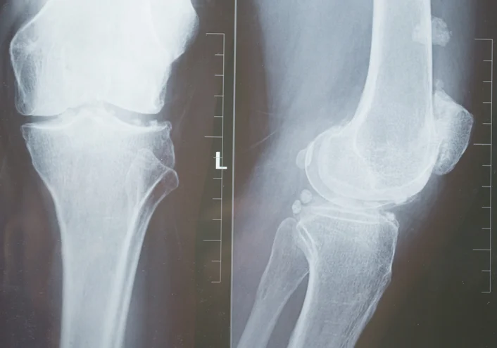 Why ACL tears are more common in females